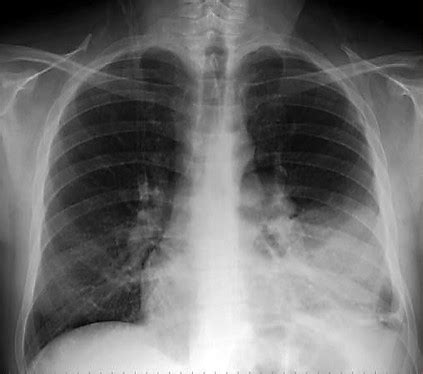 La importancia del signo de la silueta para interpretación de la ...