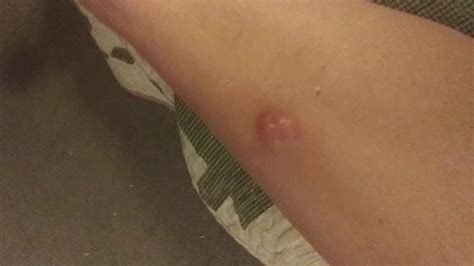 Epic Exploding Cysts 的图像结果