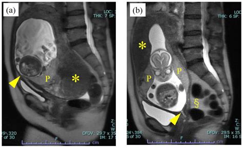 Incarcerated Gravid Uterus: Spontaneous Resolution Is Not Rare