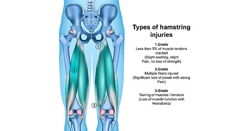 Pulled Hamstring 的图像结果