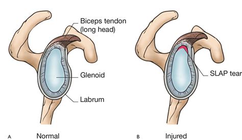 Labral tears of the shoulder: The basics - BSM Foundation