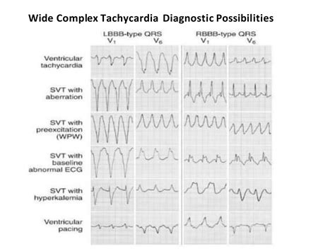 Wide QRS Complex Tachycardia (VT vs SVT) | PPTX