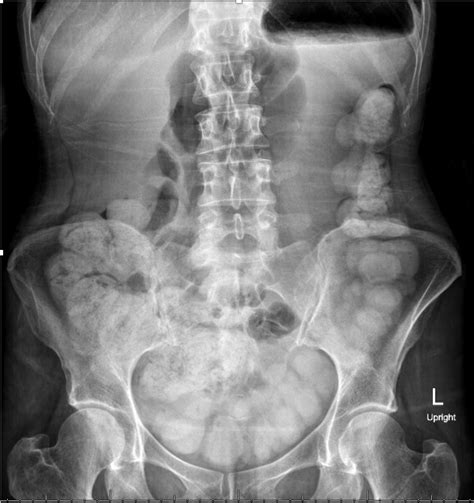 Bidirectional endoscopic and pharmacological approach for the treatment of severe right-sided ...