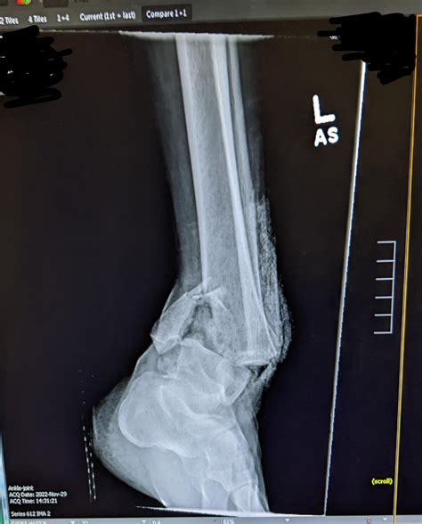 Compound fracture of tib/fib : r/Radiology