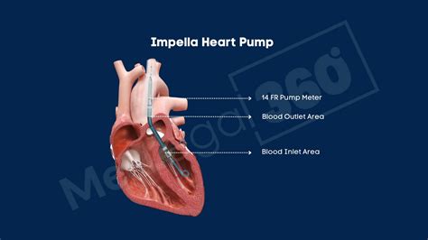 Abiomed Impella Heart Pump Lawsuits 2025 Update