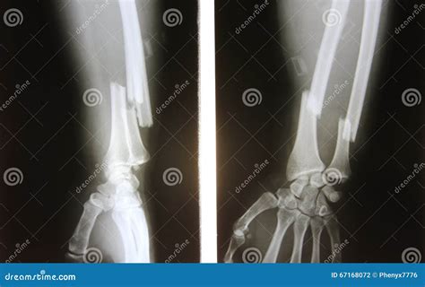 X-ray Image Of Forearm, AP View (Antero-posterior View, Show Fracture Of Ulna And Radius Stock ...