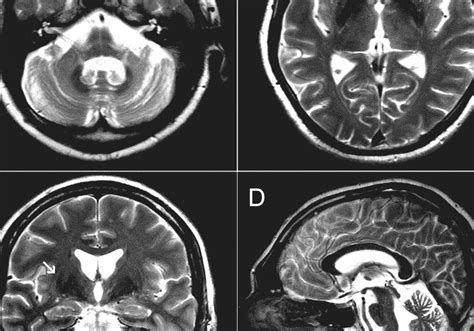 Image result for Multiple System Atrophy