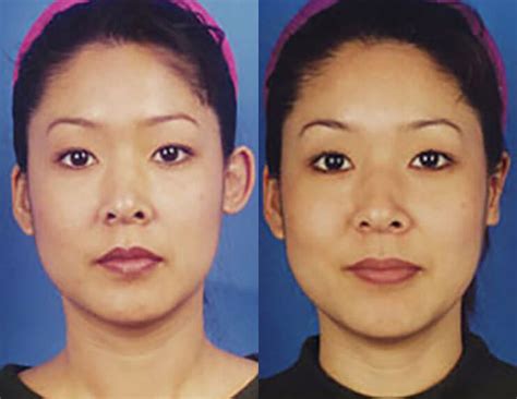 Image result for Ear Modification