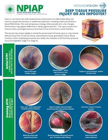 Image result for Deep Tissue Pi