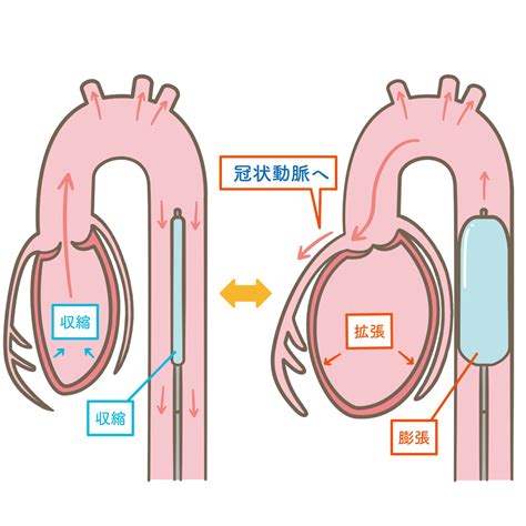 大動脈バルーンパンピング（IABP）のイラスト🎨【フリー素材】｜看護roo![カンゴルー]