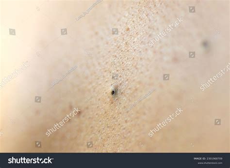 Close-up Blackheads Pimple On Back Young Stock Photo 2301968709 ...