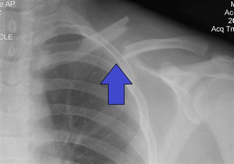 Clavicle Fracture (Broken Collarbone): Diagnosis, Treatment Options ...