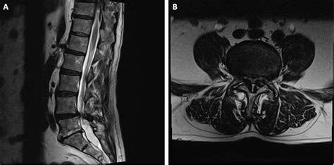 Flexion Extension Spondylolisthesis at Hayley Athaldo blog