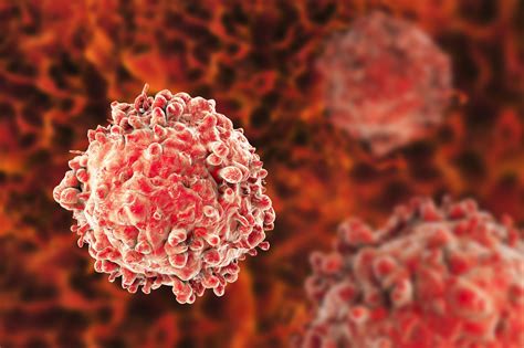 Leucemia linfocítica aguda: MedlinePlus en español