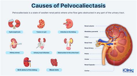 What Is Pelvocaliectasis?