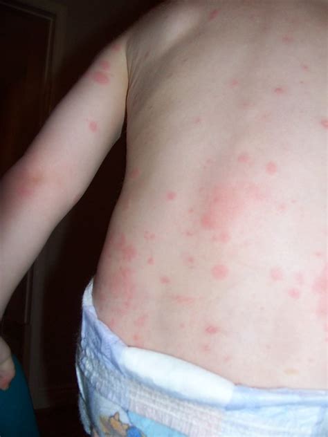 Kuvatulokset haulle penicillin allergy