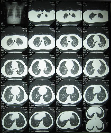 双上肺陈旧性肺结核 右中肺野钙化灶_第二人生