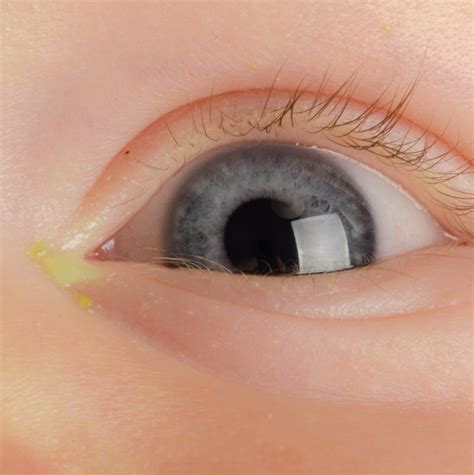 Conjunctivitis in Children: Symptoms and Treatments
