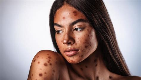Woman with monkeypox skin lesions on face and body | Premium AI ...