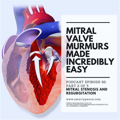 Mitral Insufficiency Murmur Sound Heart Murmur Harvard Health
