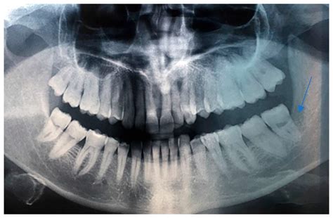 Kaposiform Hemangioendothelioma of the Oral Cavity in an Adult Woman: A ...