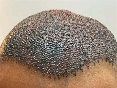 How does hair transplant work low cost hair transplant