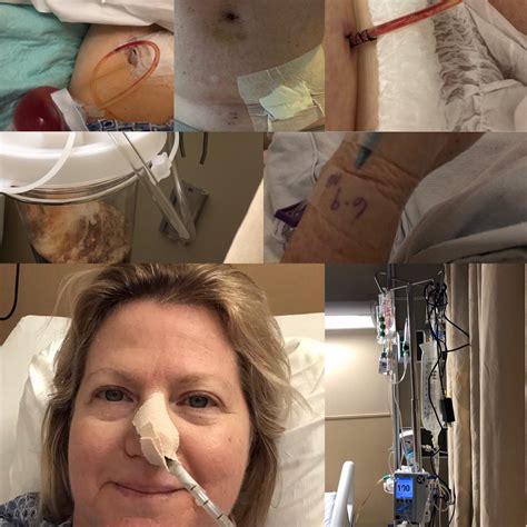 Image result for Perforated Appendix