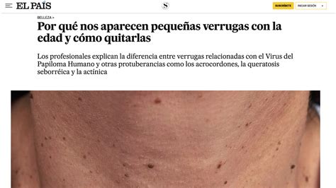 Por qué nos aparecen pequeñas verrugas con la edad y cómo quitarlas ...