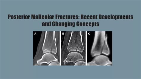 Posterior Malleolar fracture fixation | PPTX