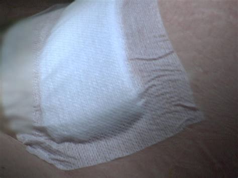 C-Section Wound 的图像结果