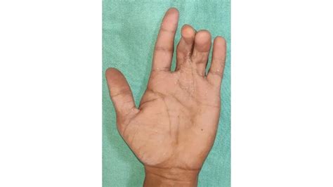 Syndactyly Surgery in Lucknow | Kayakriti