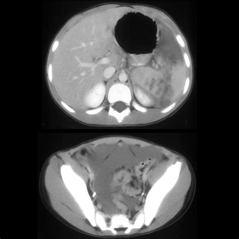 Pediatric Splenic Trauma | Pediatric Radiology Reference Article ...