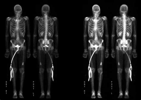 Image result for Normal Bone Scan