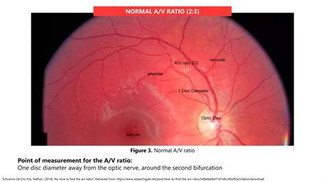 Av Ratio