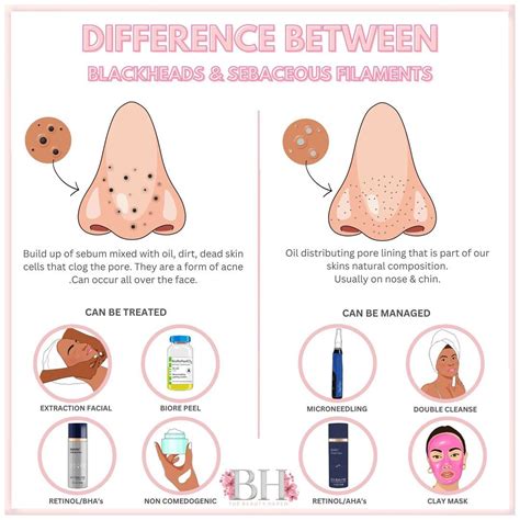 The difference between blackheads & sebaceous filaments are so important! | Sebaceous filaments ...