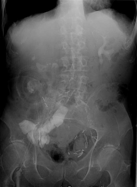 Image result for Distal Loopogram