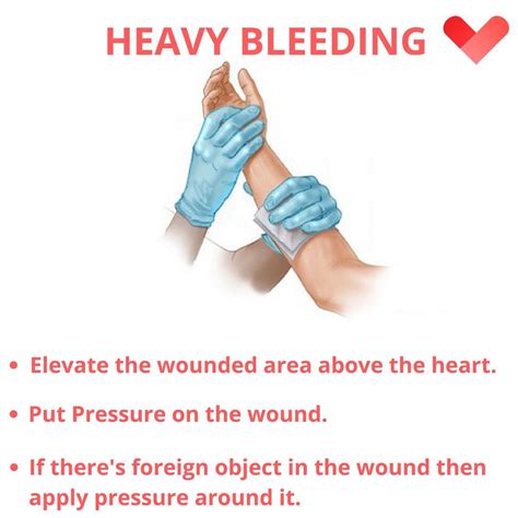 First Aid Heavy Bleeding 的图像结果