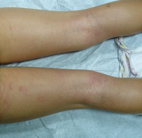 Case report of severe refractory inflammatory dermatoses in a young ...