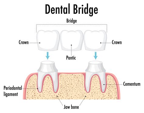 Dental Caps And Bridges
