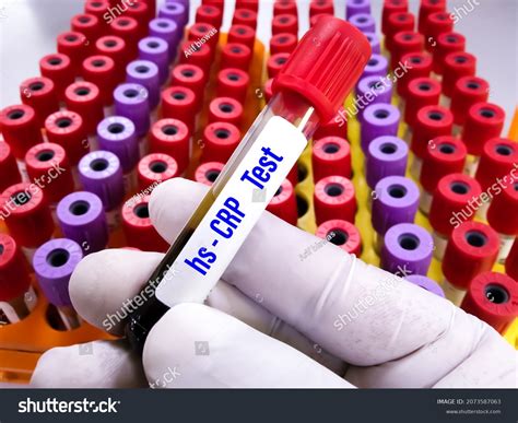 Blood Tube Colour Crp at Jerry Eberhardt blog