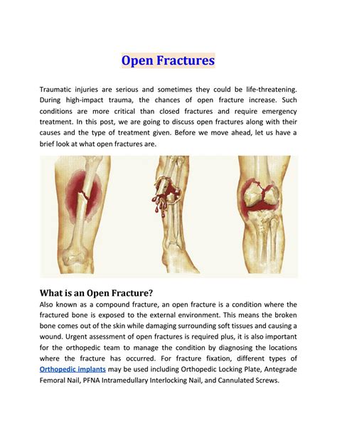 Understanding An Open Fracture – JQMCLV