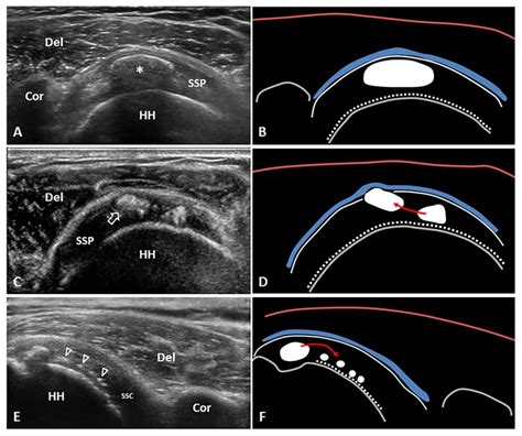 Calcification Tendonitis How