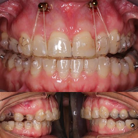 Smart Aligner 的图像结果