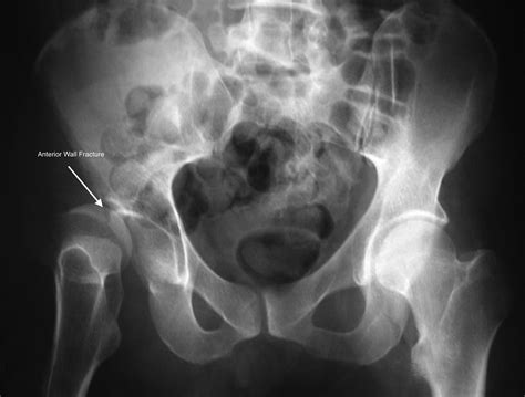 Acetabular Fractures - Trauma - Orthobullets