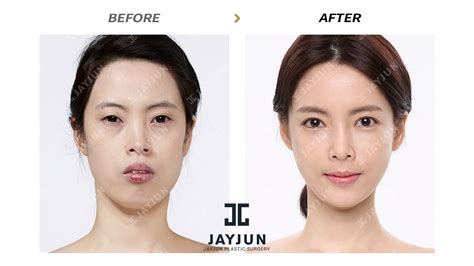 How Much Does Face Surgery Cost In Korea