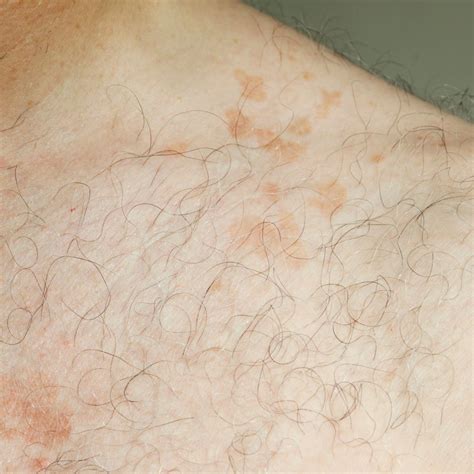 Tinea Versicolor