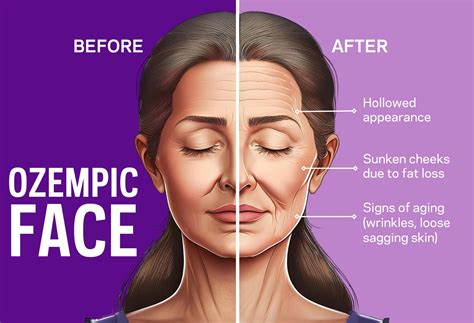 Ozempic face: what it is, how to treat it | Northwell Health