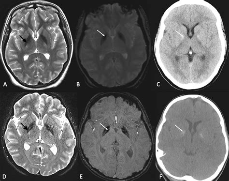 Abnormal Brain Iron Accumulation is a Rare Finding in Down Syndrome ...