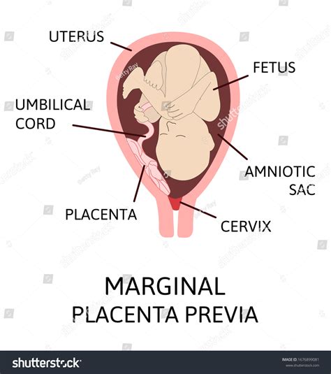 Marginal Placenta Previa