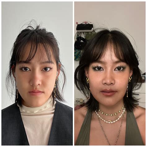 1 month post op with pics (double jaw surgery for underbite), no regrets! : r/jawsurgery